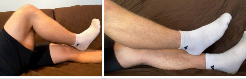 Heel-to-shin test for cerebellar coordination during neurological examination